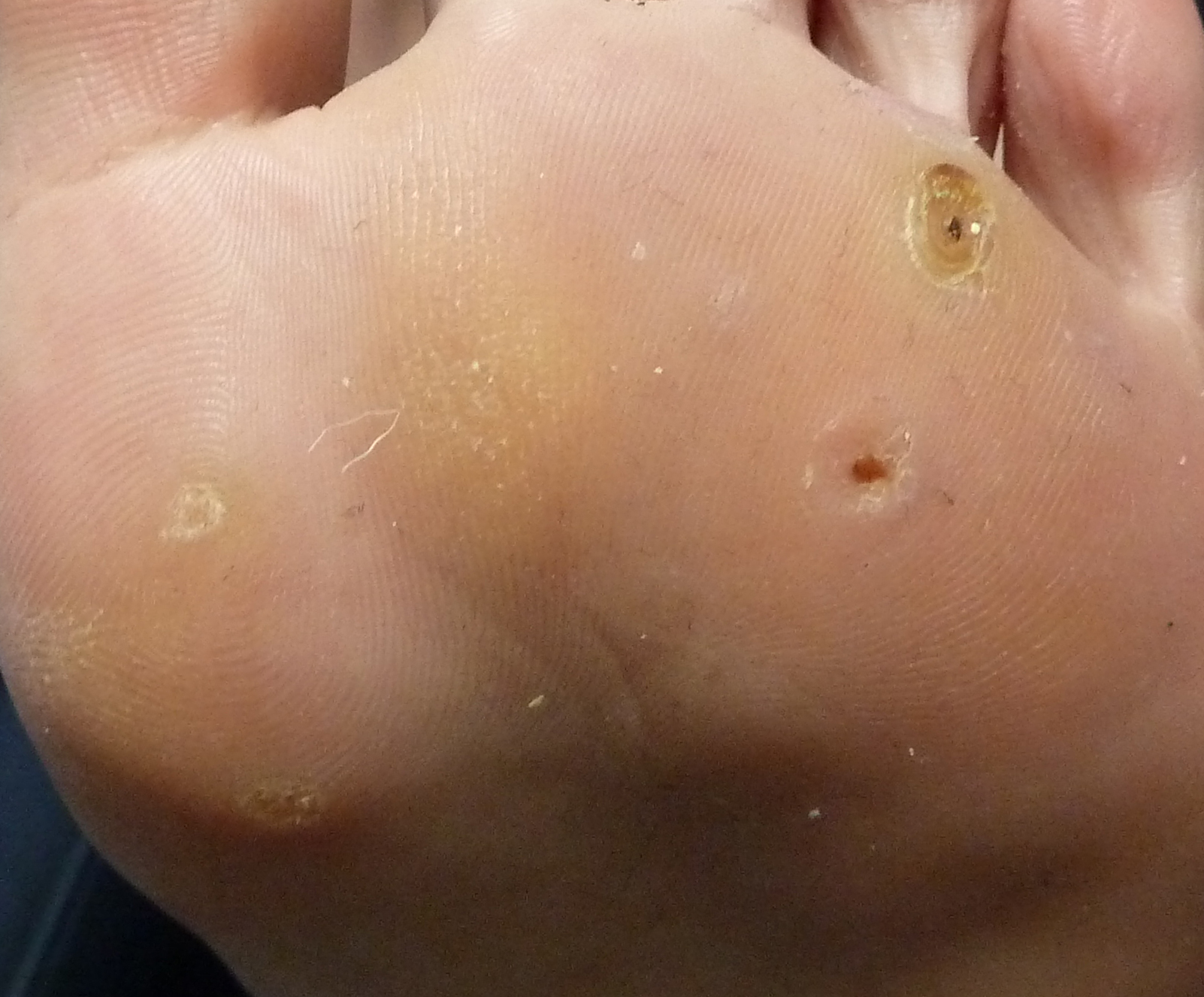 Plantar wart surgical removal Idea