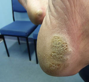 Plantar Warts Roots