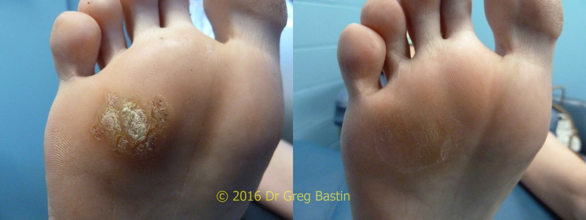 laser treatment for plantar warts