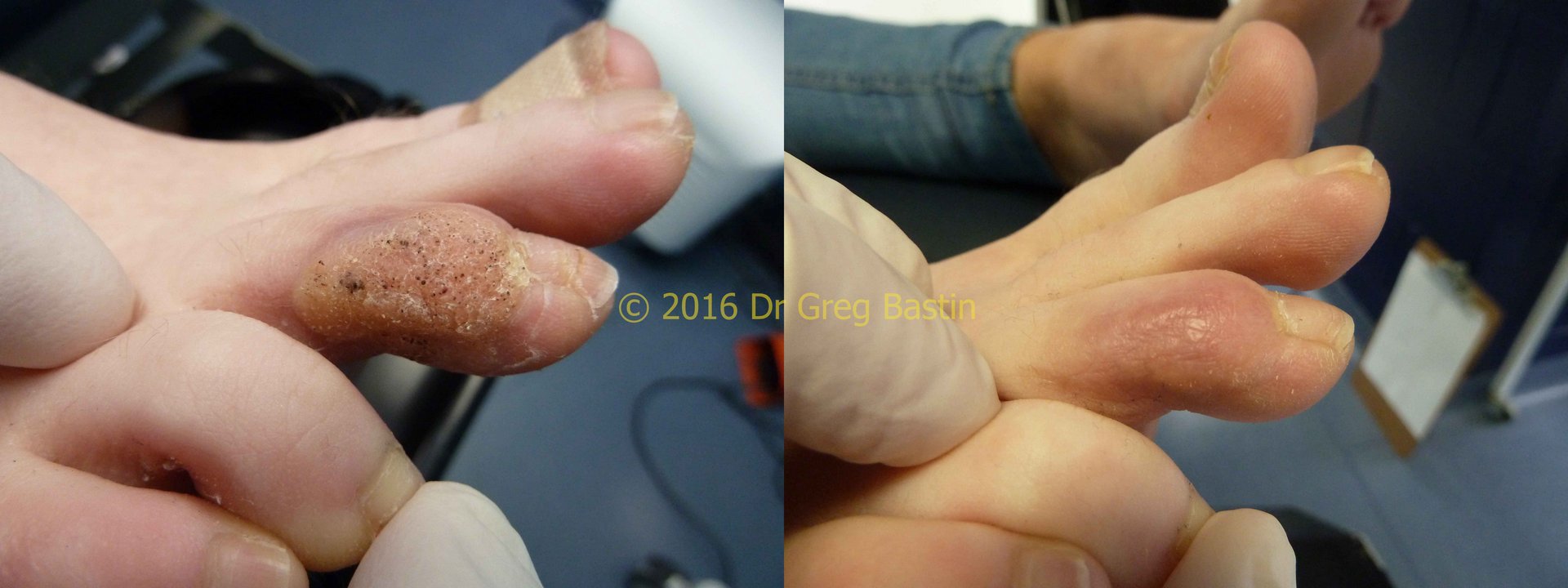 wart on toe