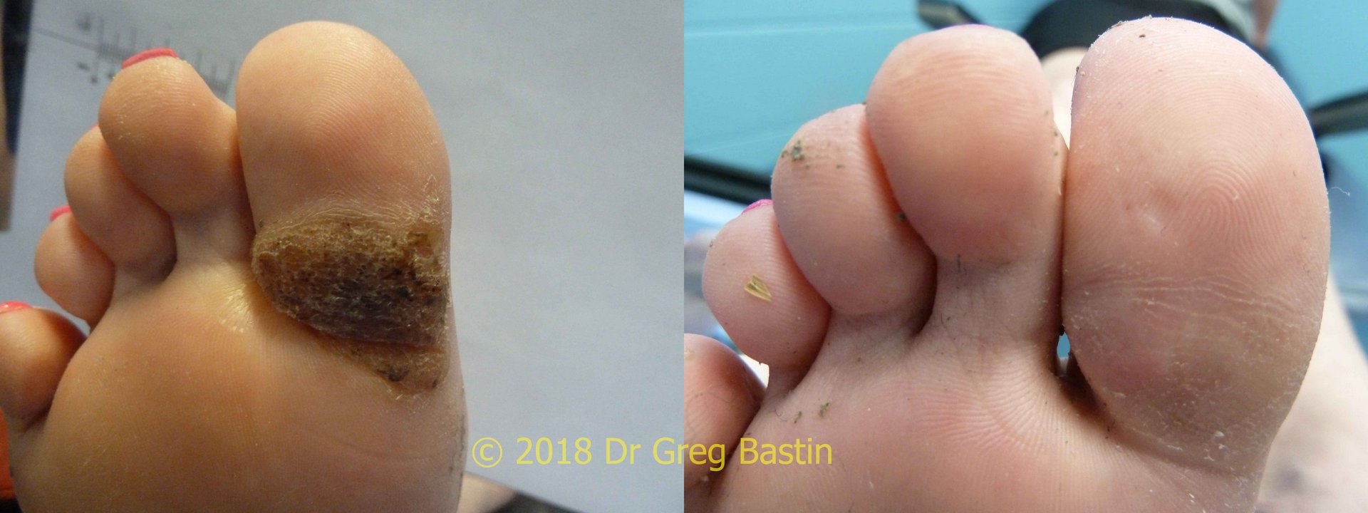 best dermatologist for plantar warts in melbourne