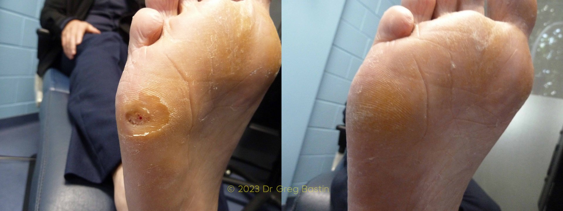 wart treatment bayside